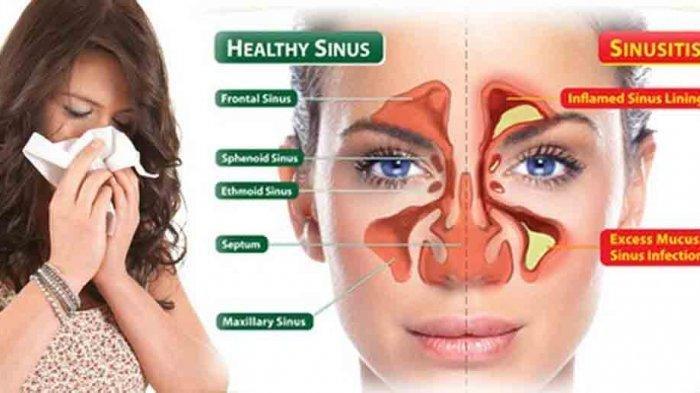 Sinusitis: Waspadai  10 Tanda Awal pada Orang Dewasa yang Sering Terlewatkan