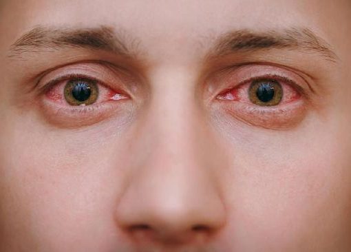 Bahaya Iritasi merah yang menonjol dengan pembuluh darah yang jelas terlihat, hasil dari reaksi alergi