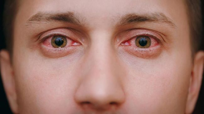 Bahaya Iritasi merah yang menonjol dengan pembuluh darah yang jelas terlihat, hasil dari reaksi alergi