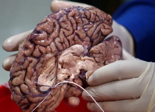 Bahaya Tumor Otak bagi Manusia: Jangan Abaikan Sakit Kepala!  Apa Tumor Otak