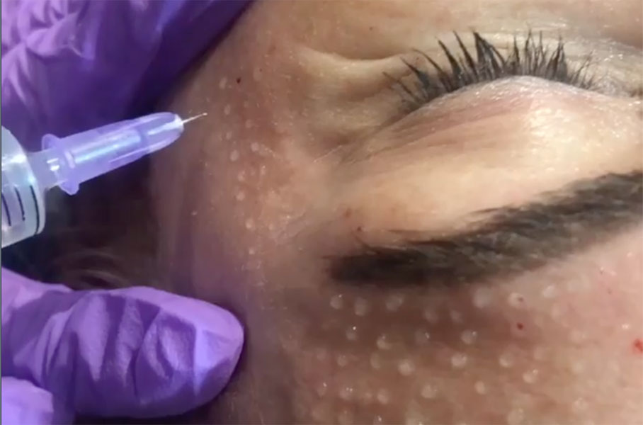 Mesotherapy