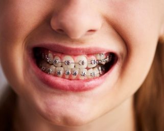 MonaLesa Bracket: Solusi Cerdas untuk Senyum Sempurna