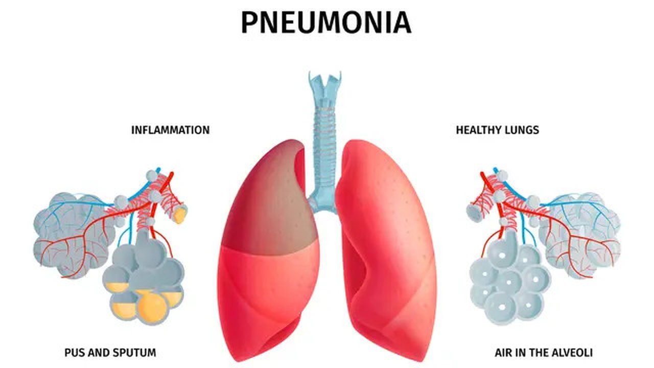 Cegah Pneumonia