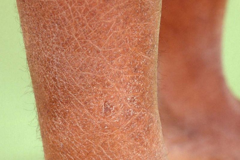 Penyebab Kulit Kering